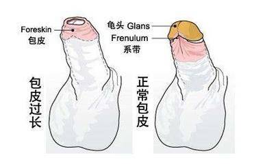 包皮过长会导致阴茎癌？包茎过长的危害