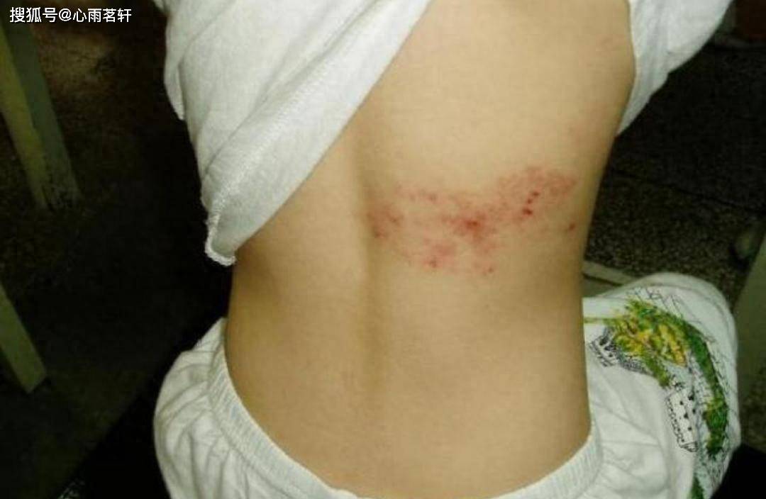 季德胜蛇药片治疗：黄蜂蛰伤疼痛，带状疱疹疼痛，痛风性关节炎