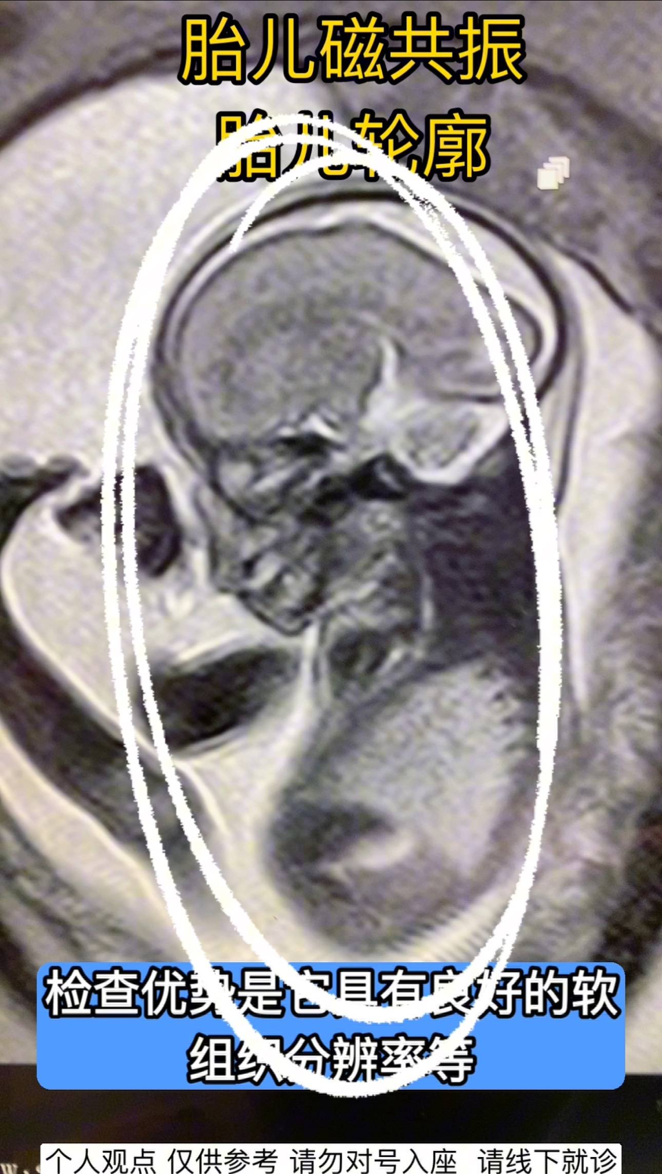 胎儿头颅 磁共振排畸 多方位多序列