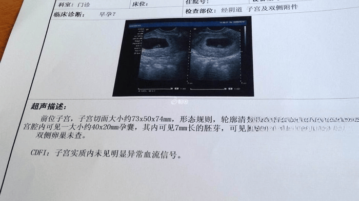 孕囊形状怎么看男女？附具体方法及对比图片