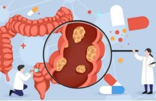 结肠癌仅仅手术是不够的！别等到没办法了才把中药当救命稻草！