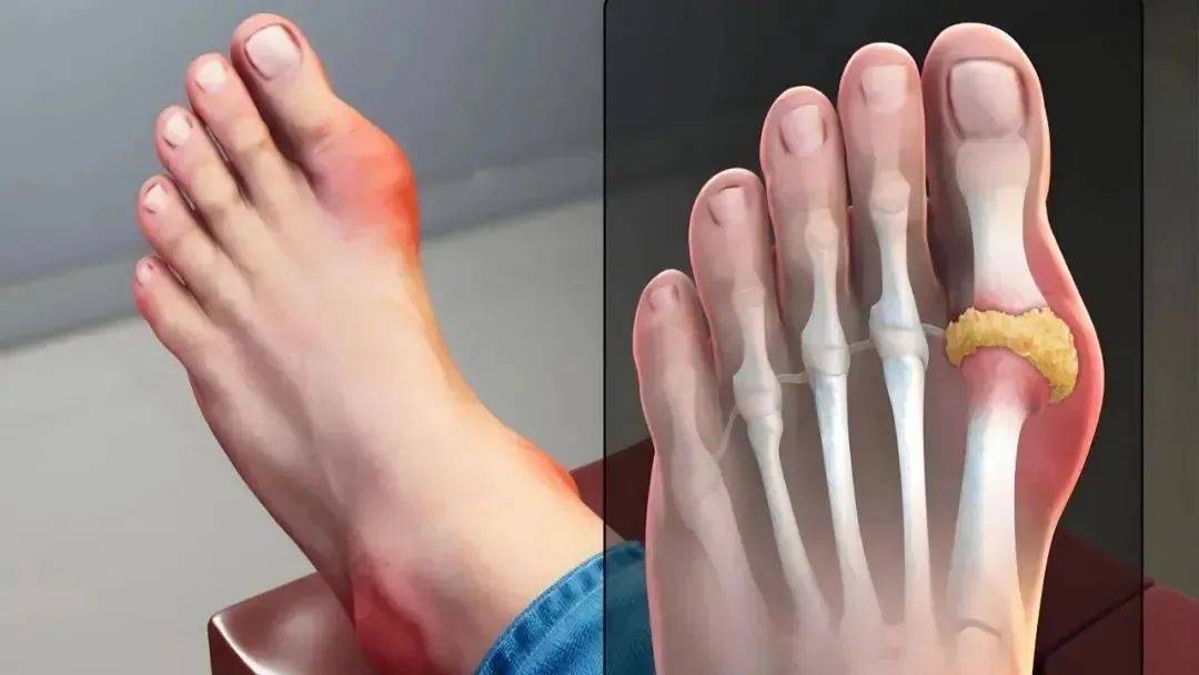 秋风起，痛风来！高尿酸人群小心“低温杀”