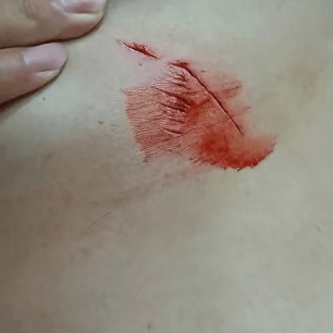 罕见！大连钓友钓到一条20斤大鲅鱼，反被鲅鱼利齿咬伤胸部