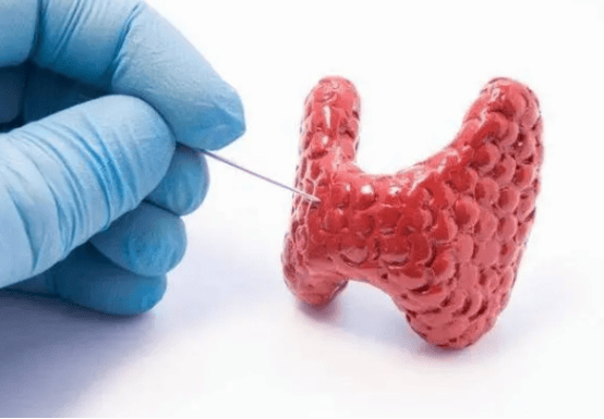 失眠多梦且疲劳难消？别让这类甲状腺状况悄悄靠近