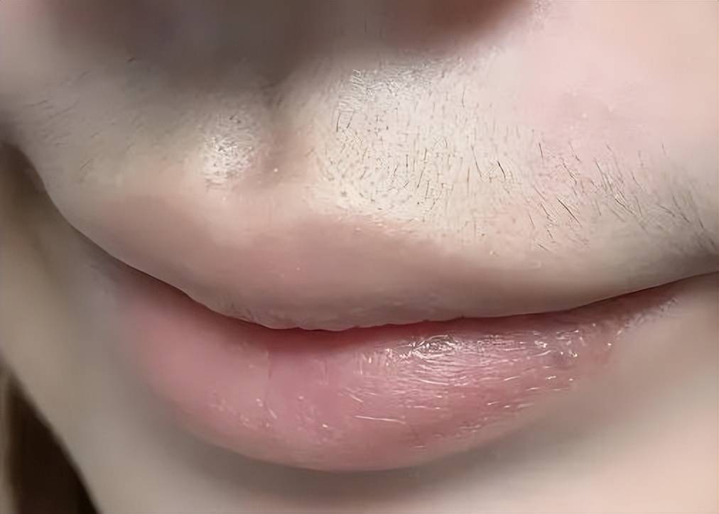 告别“小胡子”：激光脱唇毛