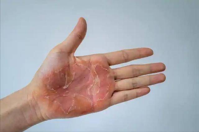 湿疹不敢吃鸡蛋？医生告诫：不想病情反复，这5种食物要忌口