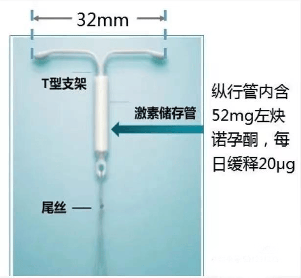 告别 “环环干扰”！北京固定专利术让曼月乐独立稳存，不脱落！