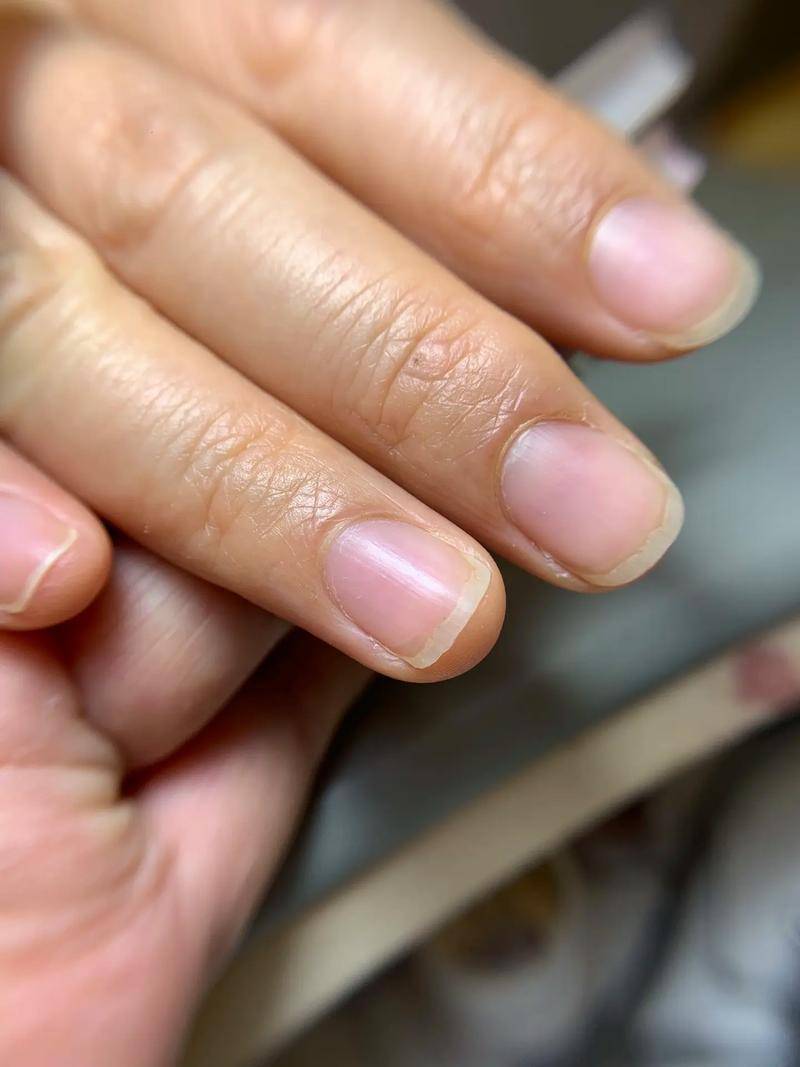 灰指甲去医院看有用吗