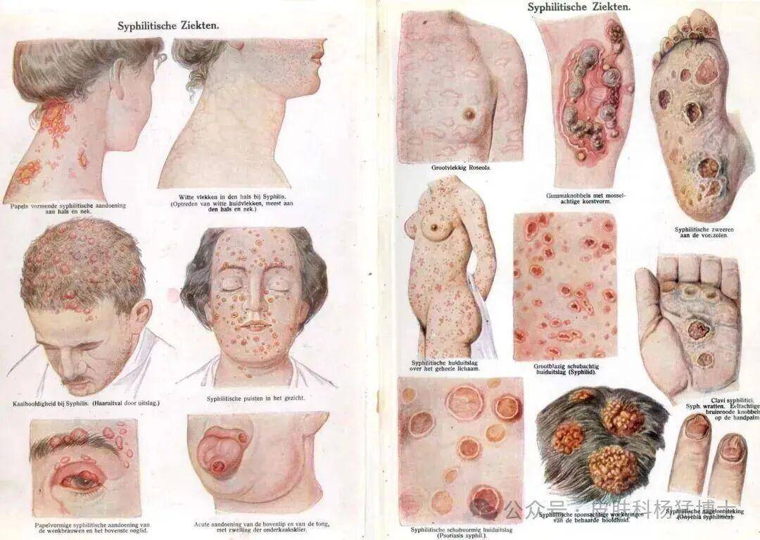梅毒被称为“伟大的模仿者”。梅毒：医学界的'千面模仿者'