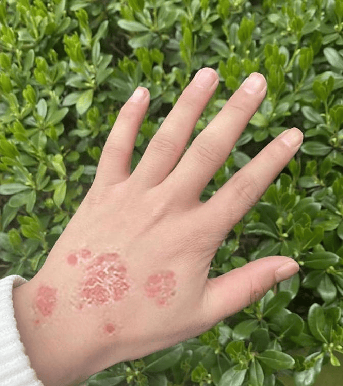 牛皮癣蜕皮期结束，皮肤新生变光滑！