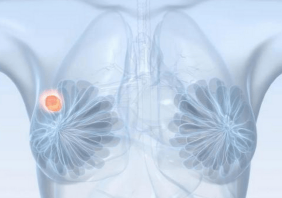 左兴旺主任：女性预防乳腺癌有妙招？