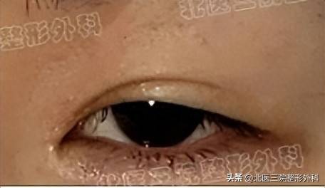 被上睑下垂困扰？别急着割双眼皮