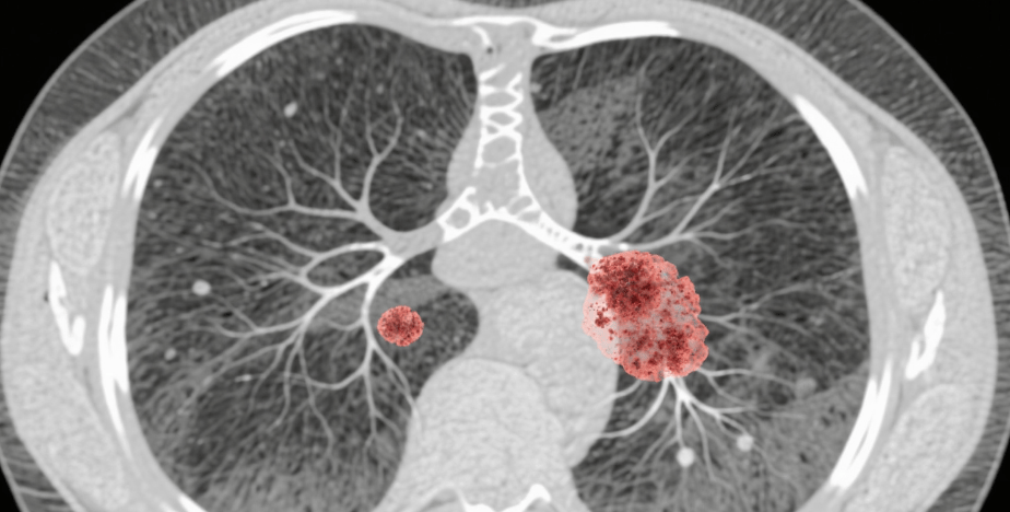 放疗+免疫治疗，肺癌晚期患者5年生存率提升50%！