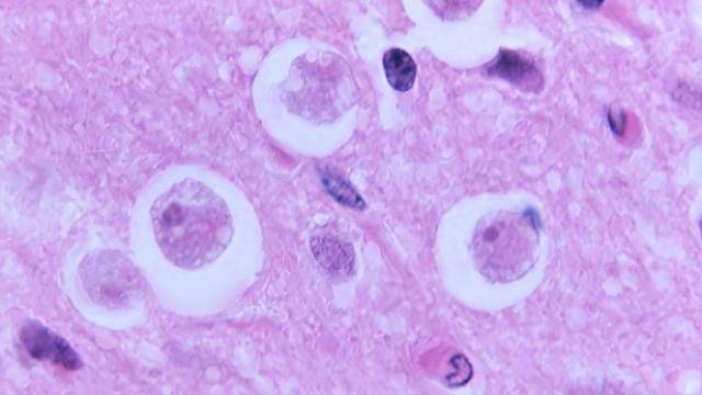 原创            全球存活率不足3%！印度突现“食脑虫”疫情，婴儿老人全部中招