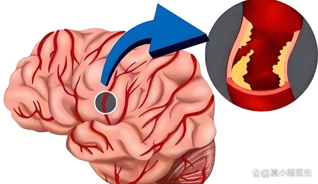 脑血栓是如何形成的？又该如何科学应对？