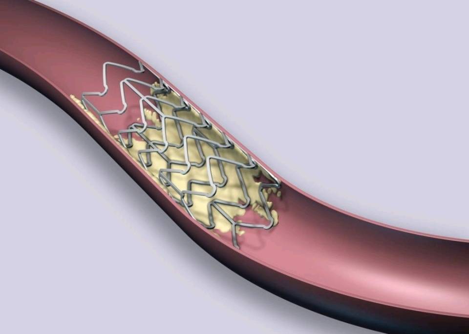 阿司匹林和氯吡格雷一起吃，到底要坚持多久？医生一次性讲清楚