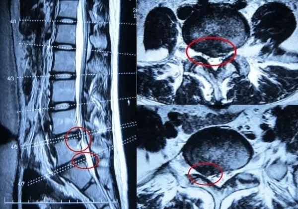 腰椎间盘突出如何做好防护？