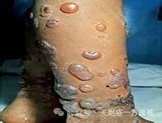 健脾祛湿解毒方辨治天疱疮十日内获效浅析