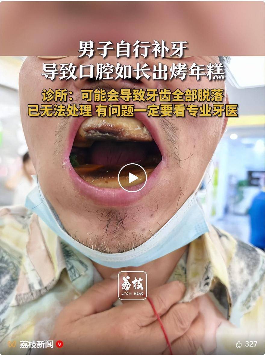 男子买5元树脂自行补牙，口腔如长出“烤年糕”，诊所回应：无法处理，可能会导致牙齿全部脱落