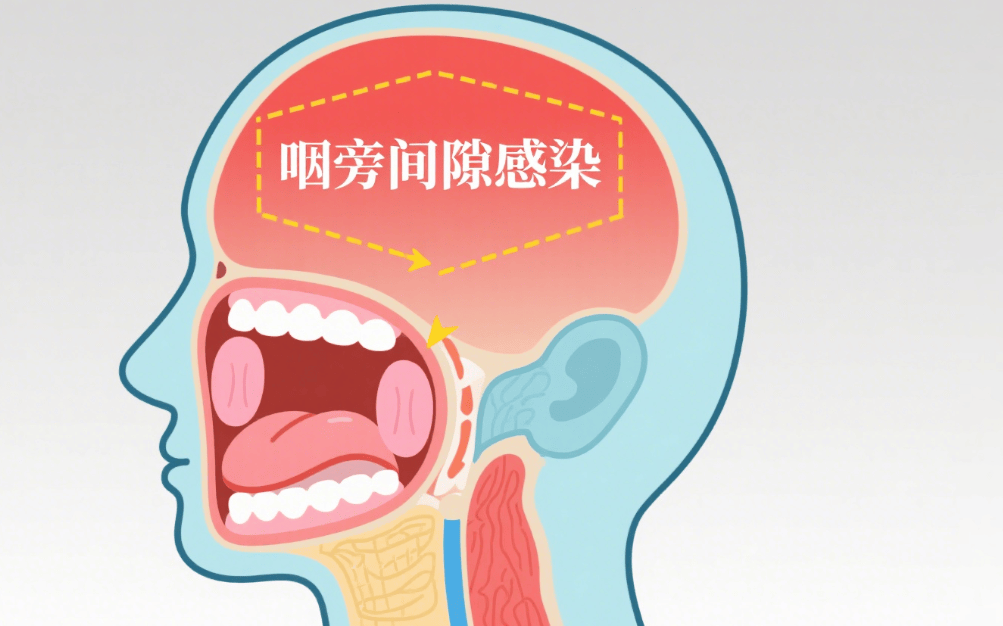 “小咽痛”险要命！七旬老人命悬一线，一场手术抢回生机