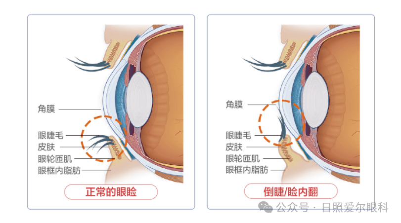 日照爱尔眼科小课堂丨娃总揉眼睛？不是小事，一张图教你快速判断
