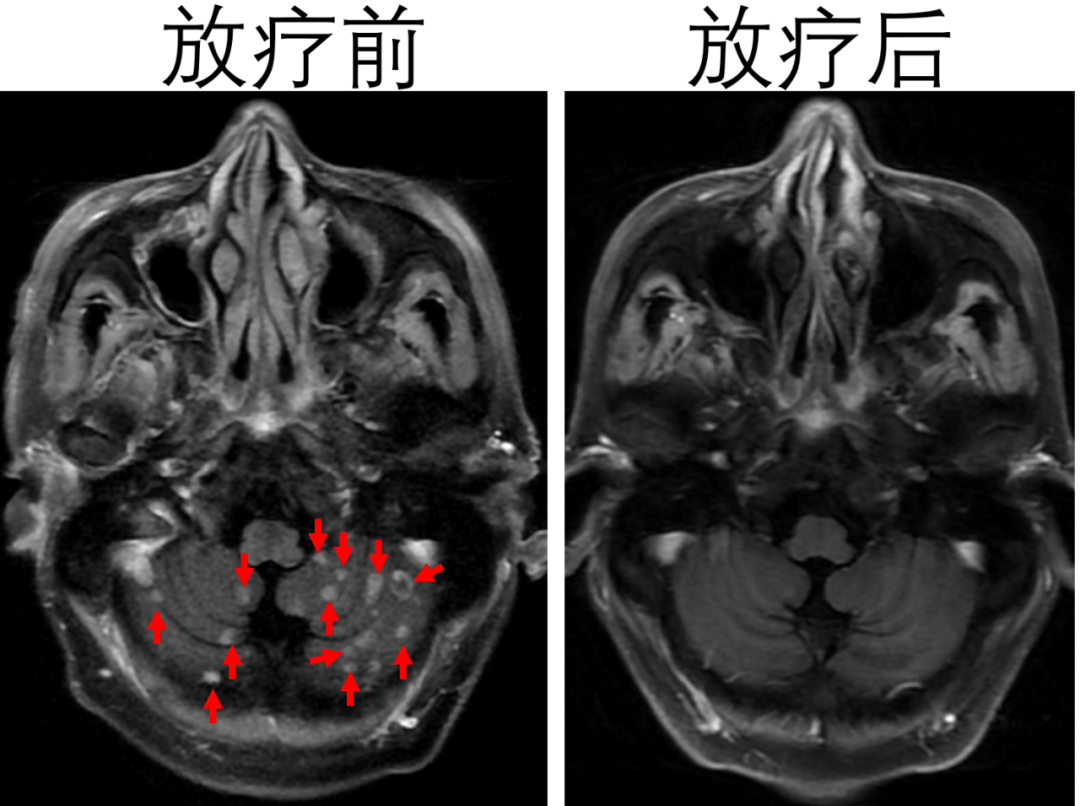 省中放疗科76||小细胞肺癌脑转移3：脑部转移触目皆是，精准放疗使其消失
