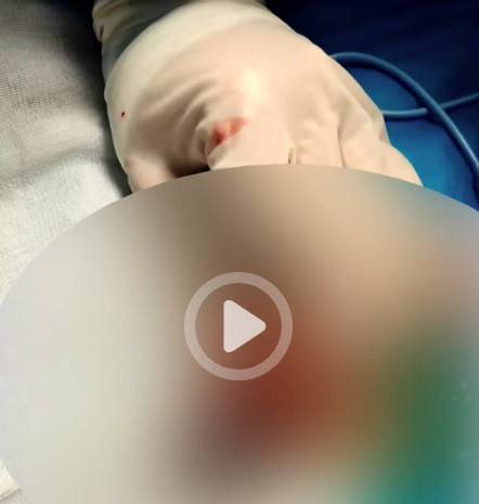 重庆13岁男孩割包皮后睾丸坏死被切除，手术器材是医生临时买的，医院：上级正在调查