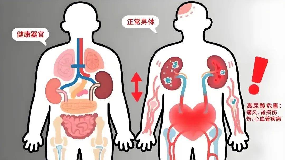 畅通无阻！4杯“降尿酸高手”悄悄排，痛风专家周桂兰教你操作！