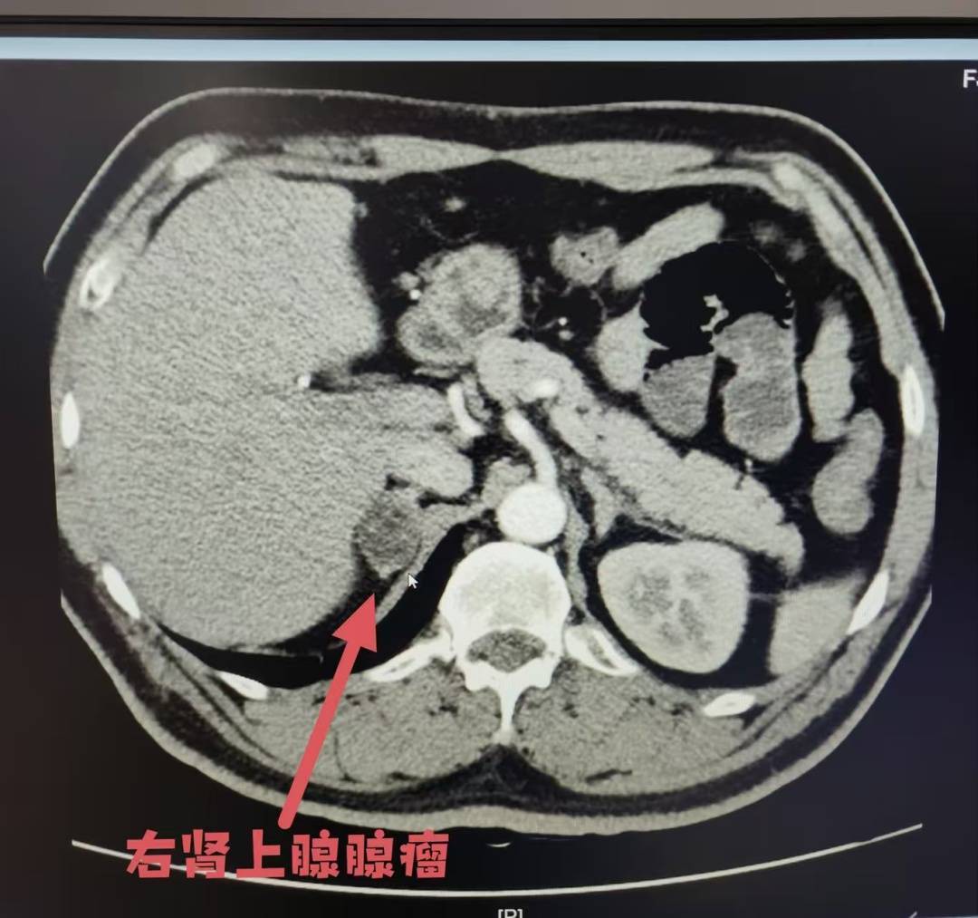才40多岁！福州男子确诊肿瘤！医生：血压异常要注意