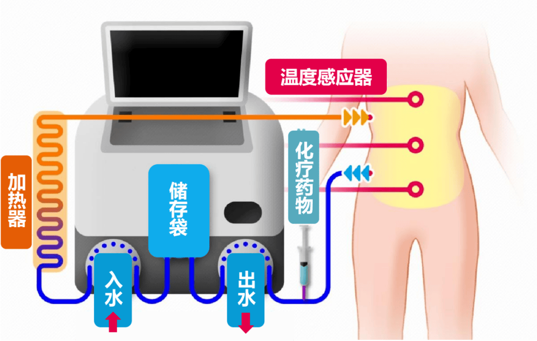 【省三院·临床服务】腹腔热灌注化疗：攻克腹腔肿瘤的“热武器”
