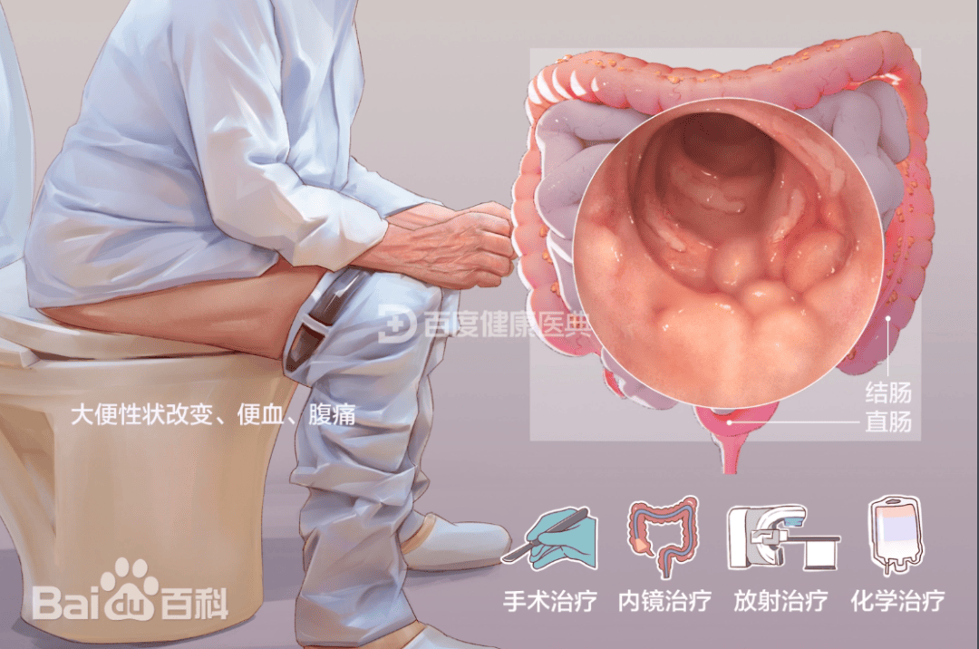 【专家在线】结直肠癌不可怕！可防可控，这些关键知识请收好