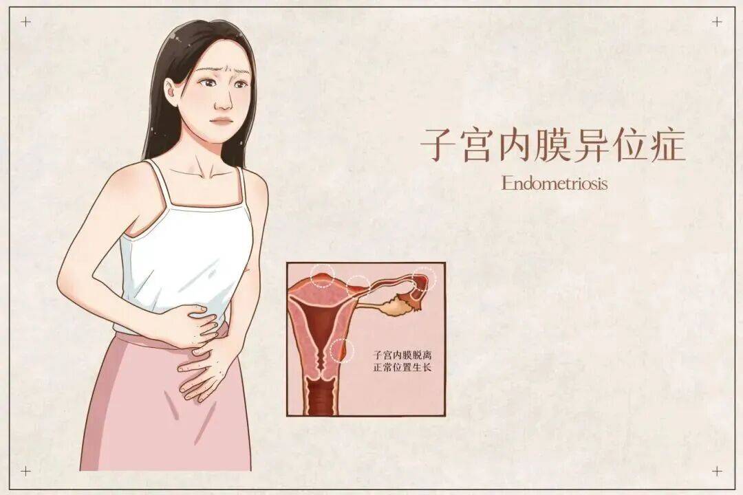 子宫内膜异位症的治疗，一场需要长期管理的“持久战”
