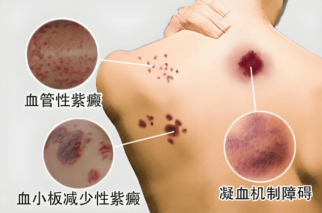杨淑莲医生：紫癜是怎么引起的,如何治疗?