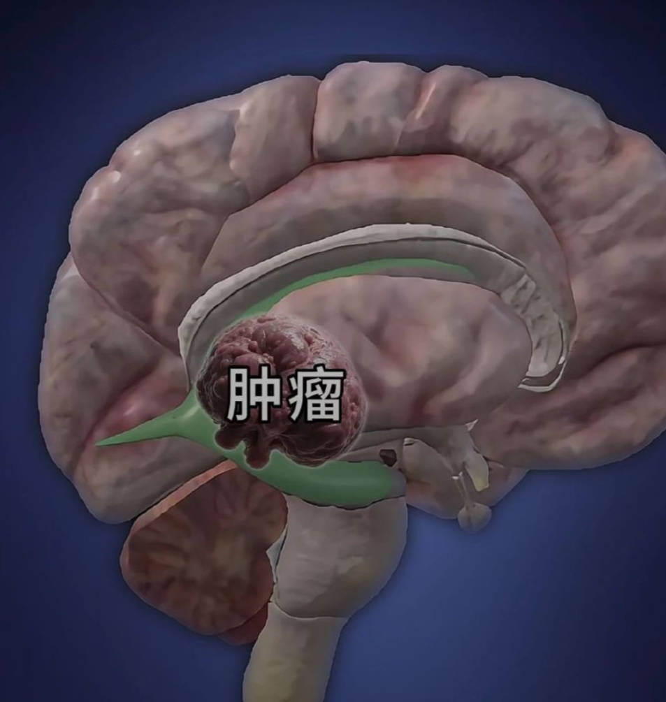 科普啦！深入了解脑部肿瘤