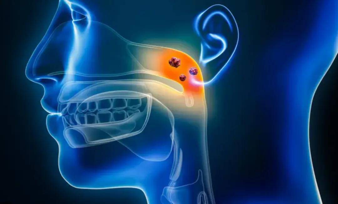 警惕！鼻咽癌早期像鼻炎、咽炎，9个信号要重视！