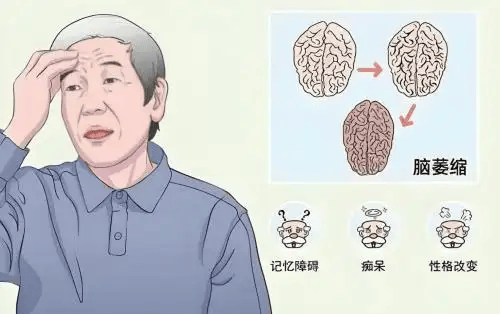 脑萎缩能逆转吗？kound脑醒素2025最新科研实证，打破认知衰退困局
