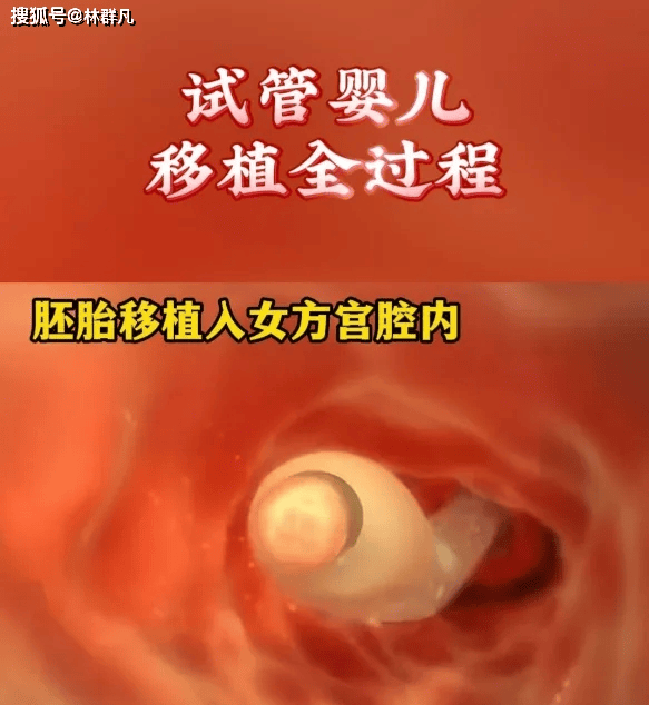 林群凡主任分享：试管移植后科学式休养，对胚胎着床更有利！