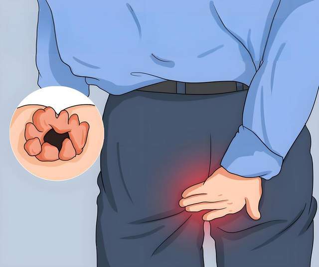 原创            痔疮不是小毛病，这5个习惯最容易患病，早期做好预防