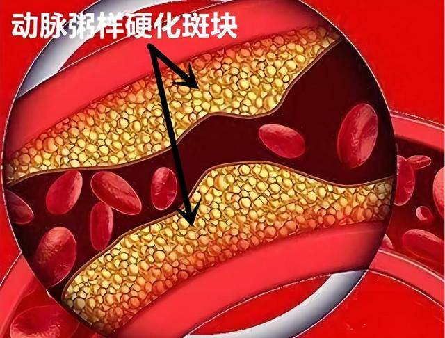 原创            木耳被盯上！医生发现：动脉硬化患者吃木耳，或有这4种好处