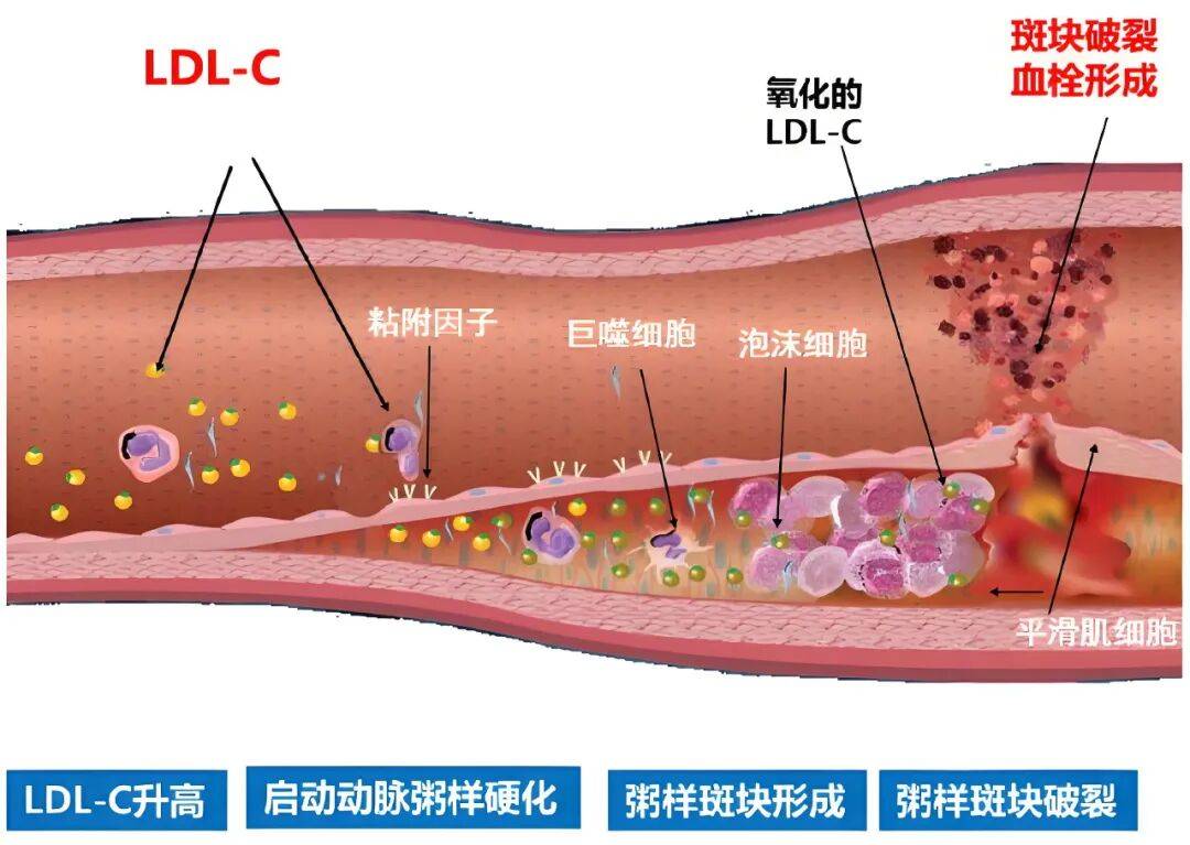 原创            国庆七天，给血管放个假：从“小米粥”到“逆生长”的奇妙之旅