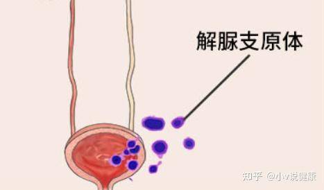 解脲支原体感染并发症的早期症状识别，早了解早预防