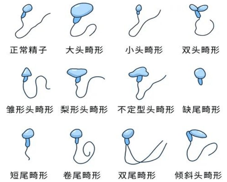 精子畸形率高（畸精症）试管选性别：第三代技术能否筛选？