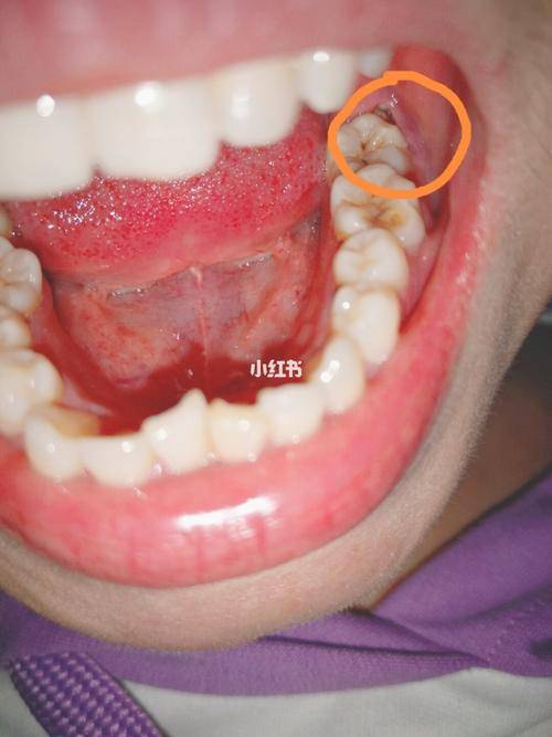 智齿反复发炎？到底拔还是留？牙医：这 3 种情况必须及时处理