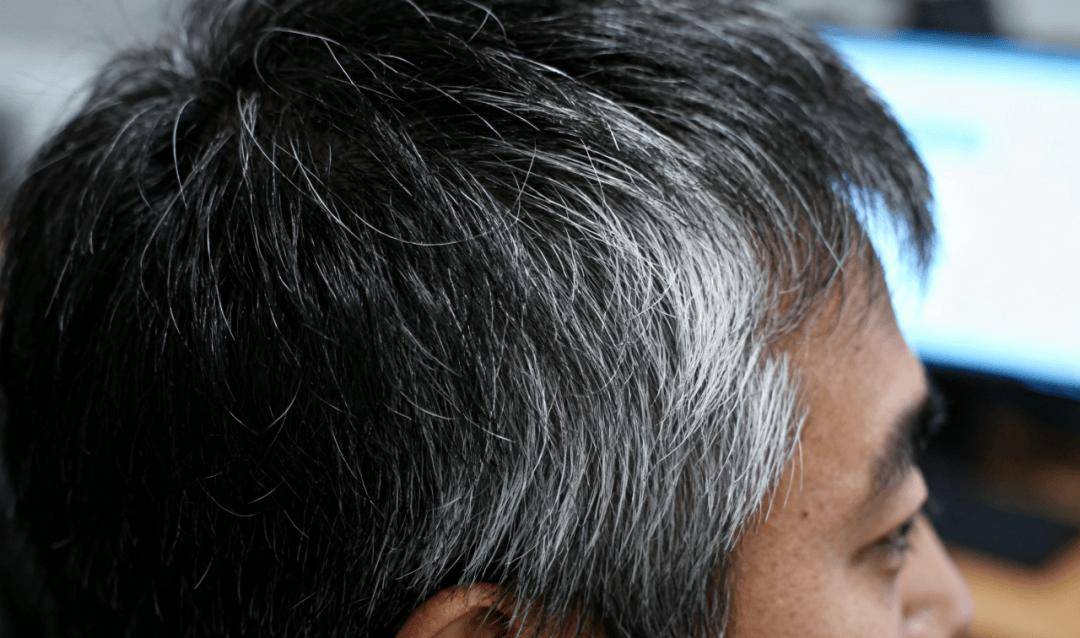 年纪轻轻长白发?这2种情况要排查!