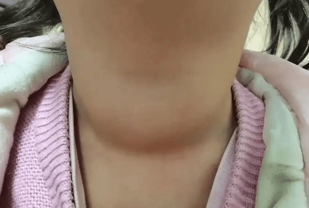 甲状腺癌术后，为什么有人恢复快有人恢复慢？