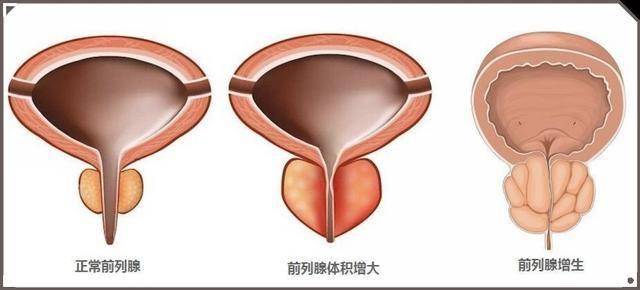 前列腺肥大排尿难？三味中药“一补一消一通”，帮你打通排尿通道