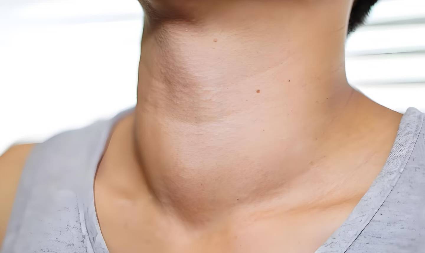 甲状腺结节钙化了，就是癌症的信号吗？