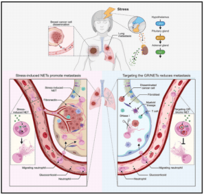 慢性压力促进癌症转移