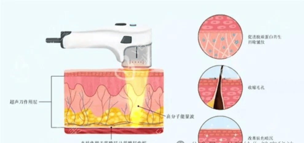 真相大揭秘：超声炮的功效与作用,抗衰超声炮的作用与功效