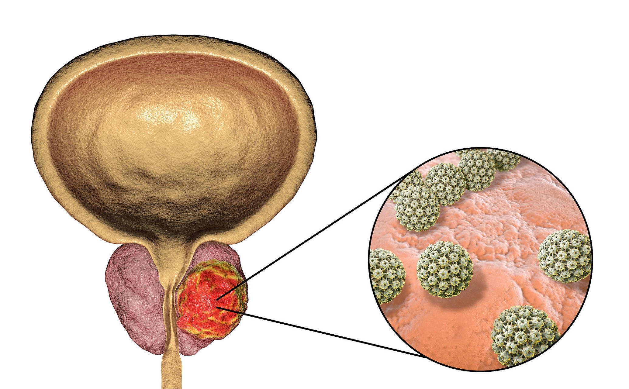 原创            奉劝男性：55岁后不想被前列腺癌“盯”上，5件事尽量少做